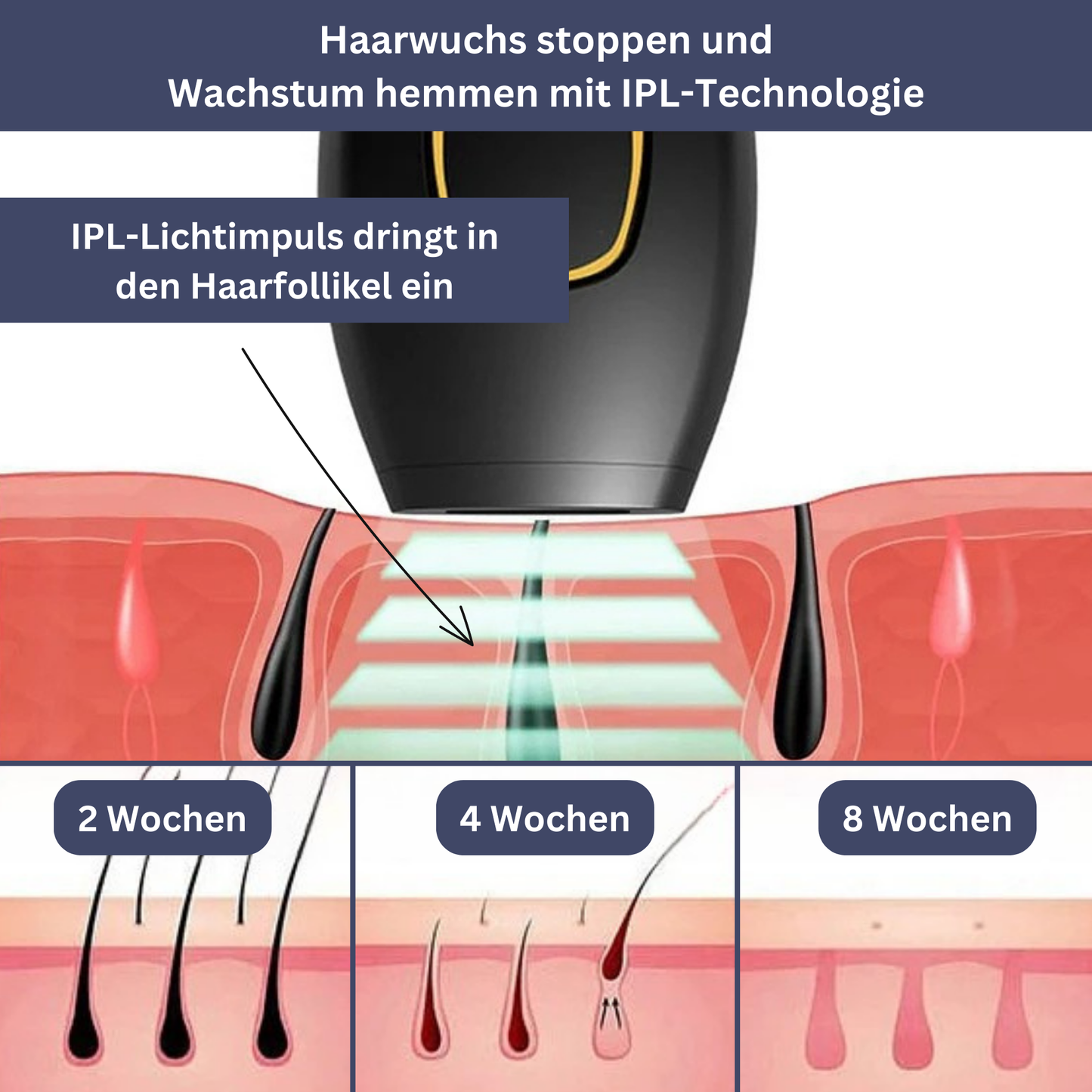 IPL-Haarentfernungsgerät